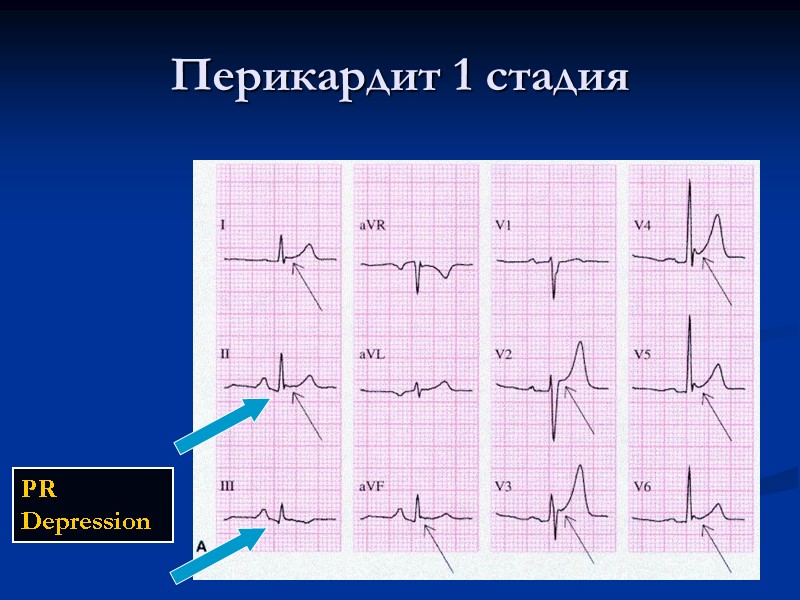 Перикардит 1 стадия PR Depression